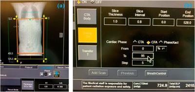 The study on the impact of AAA wall motion on the hemodynamics based on 4D CT image data